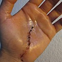 handverletzung